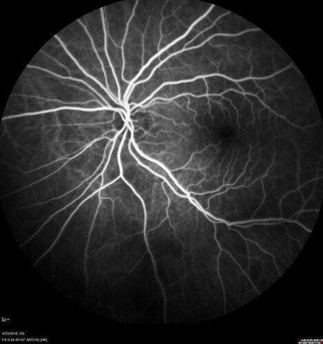 Subretinal Fluid - Inferior to the Nerve - Probable occult nerve pit
82 year old female. History of visual 