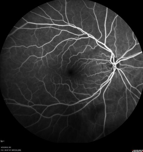 Subretinal Fluid - Inferior to the Nerve - Probable occult nerve pit
82 year old female. History of visual 