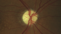 lebers_optic_atrophy_waoro_103018_02.png